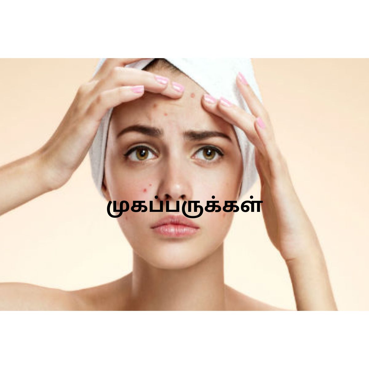 'முகப்பருக்கள்'விரட்டி அடிக்க 5 தீர்வுகள்| 5 Adorable tips for acne