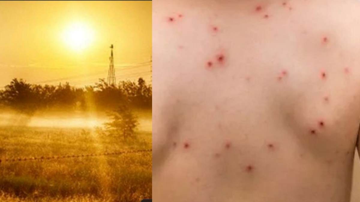 கோடை வெப்பத்தில் அம்மை நோயை தடுக்க உதவும் 5 உணவுகள்|5 Best Foods to Prevent Measles in Summer Heat