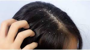 பெண்களுக்கு பொடுகு தொல்லை - வீட்டு வைத்தியம் |11 Amazing Home Remedies for Dandruff