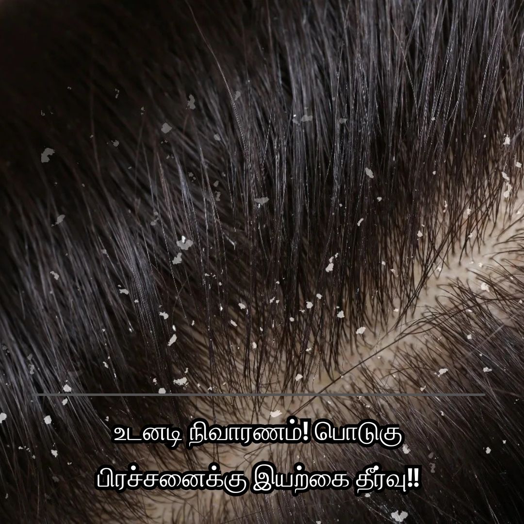 உடனடி நிவாரணம்! பொடுகு பிரச்சனைக்கு இயற்கை தீர்வு!!