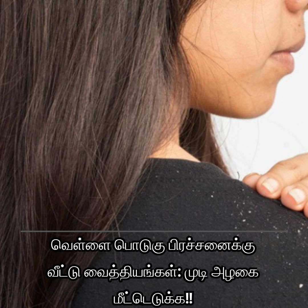 வெள்ளை பொடுகு பிரச்சனைக்கு வீட்டு வைத்தியங்கள்: முடி அழகை மீட்டெடுக்க!!