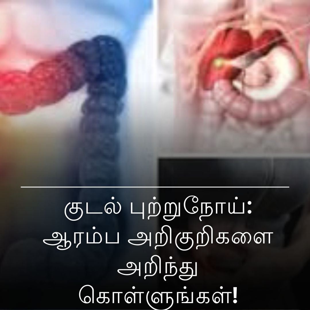 குடல் புற்றுநோய்: ஆரம்ப அறிகுறிகளை அறிந்து கொள்ளுங்கள்!